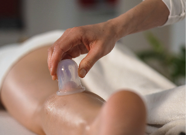 Cupping Therapy