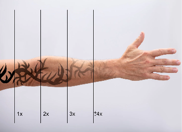 Tattoo removal
